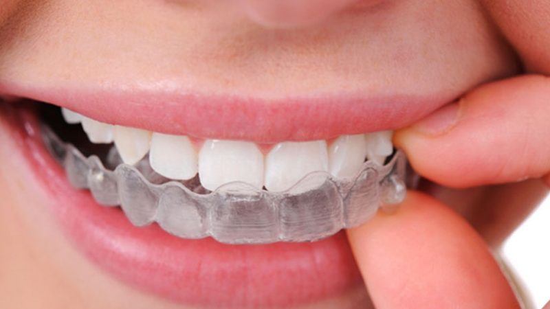 How Much Do Braces Cost for Teens?