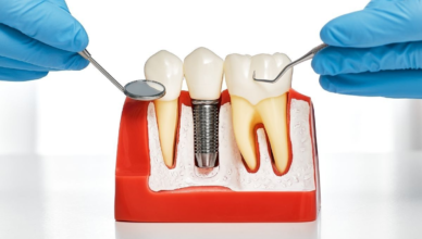 best dental implants in Agoura Hills