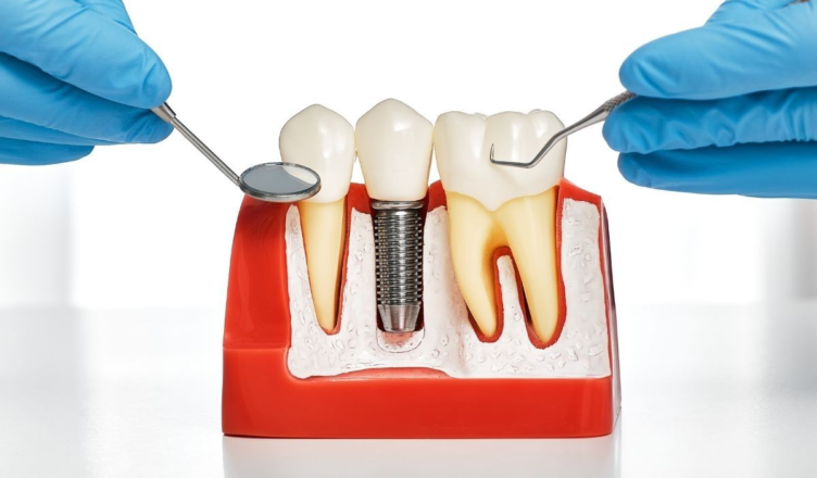 best dental implants in Agoura Hills