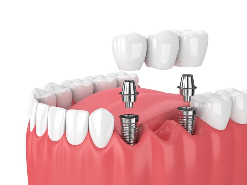 Implants in Agoura Hills