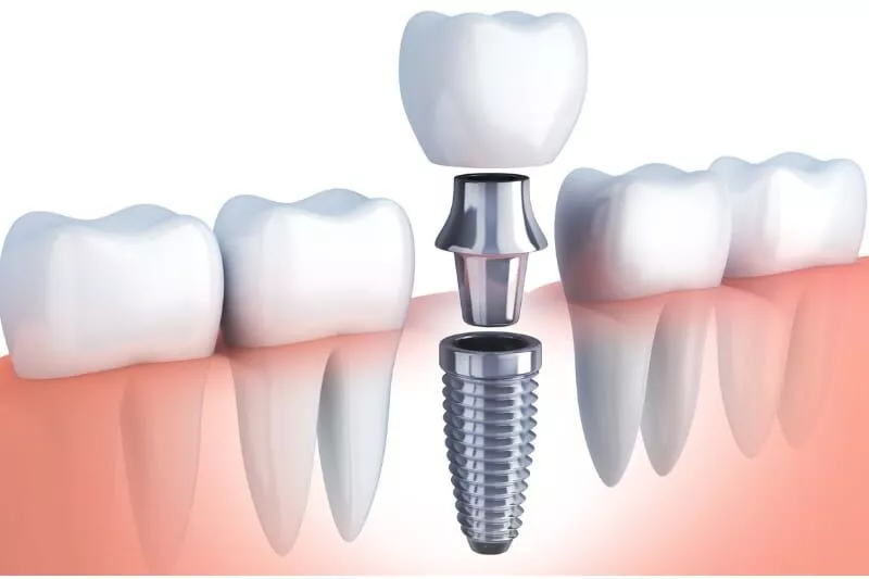 Implant dentist in Agoura Hills